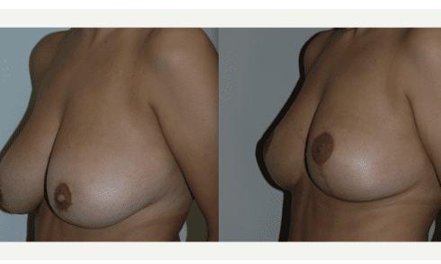 breast reduction surgery before & after