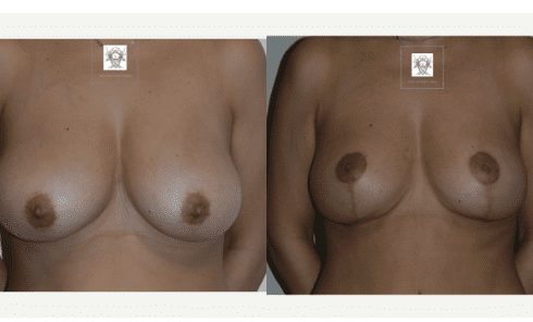 examples of breast reduction before and after surgery from star clinic manchester