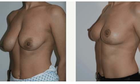 before and after breast reduction surgery manchester