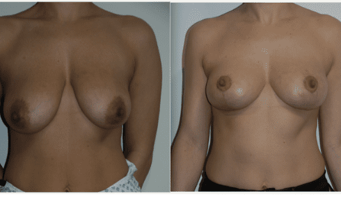 breast reduction manchester before and after