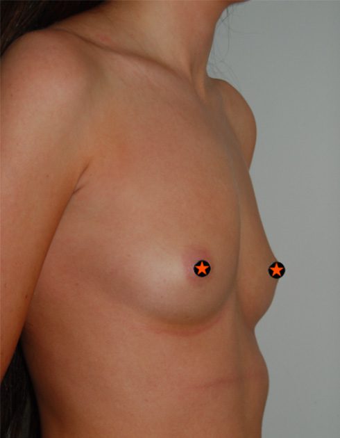 Breast Augmentation Manchester Before 2 Image