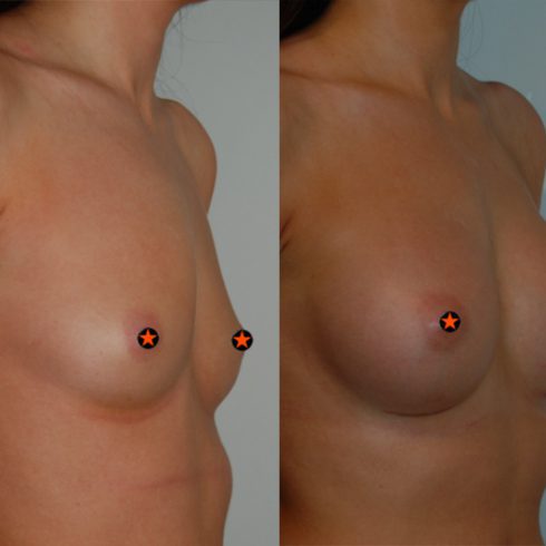 breast augmentation before and after nipples