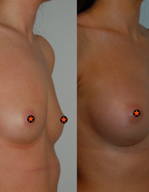 breast augmentation before and after nipples