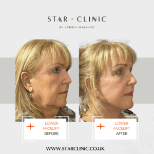 Best facelift Manchester before and after pictures